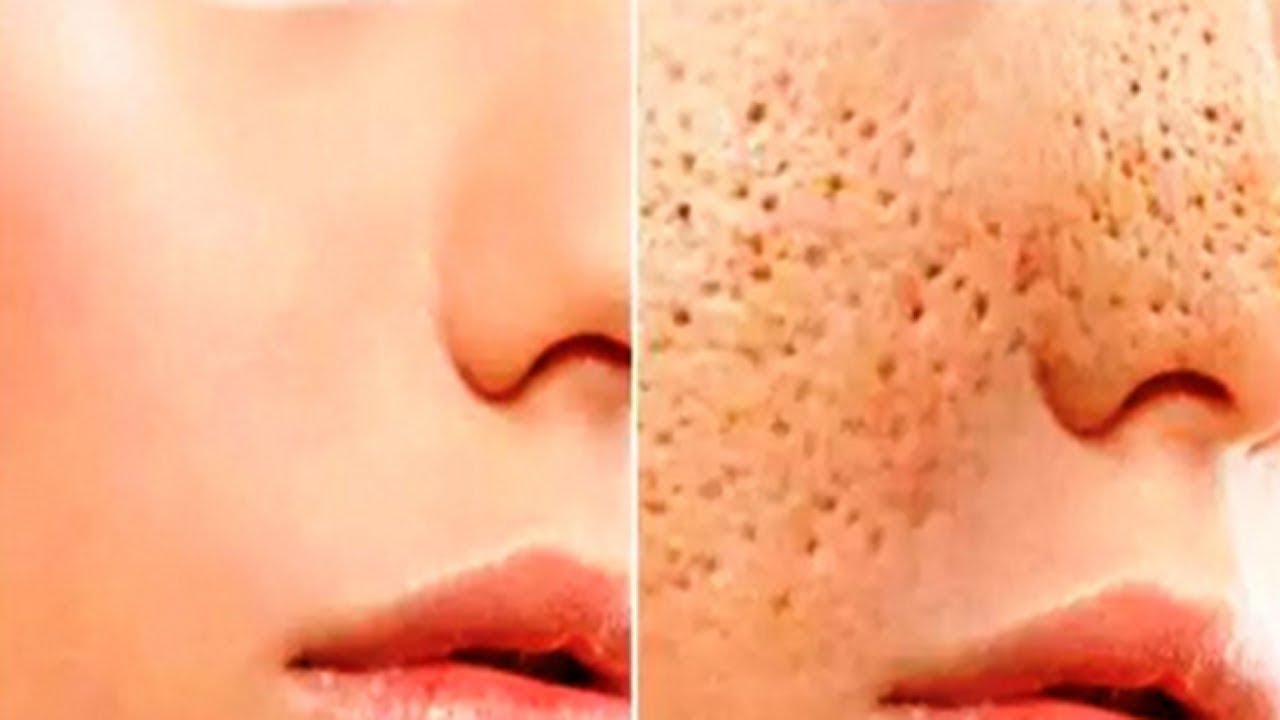 Large Open Pores Get Rid Permanently With Simple Remedy Namat Blog
